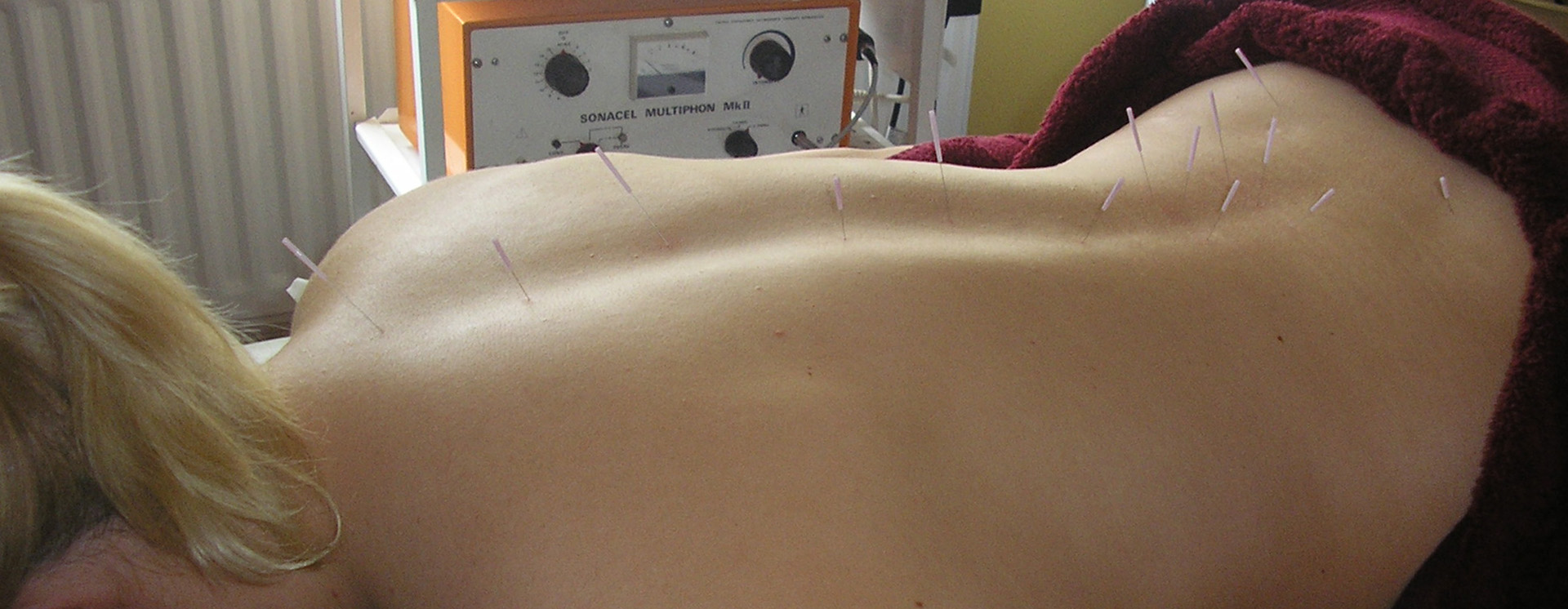 medical acupuncture