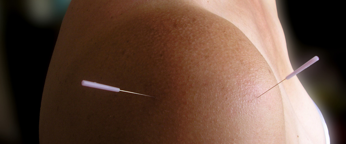 Medical Acupuncture